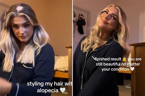 chloe peach|Woman Shares Her Hair Styling Hacks to Hide Alopecia.